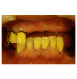 前歯の処置と症例