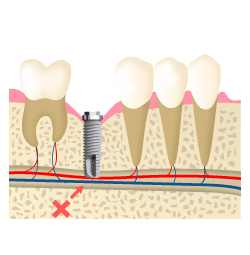 奥歯の処置と症例