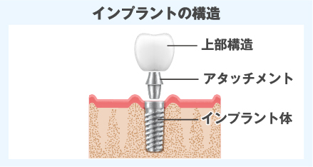 インプラントの構造