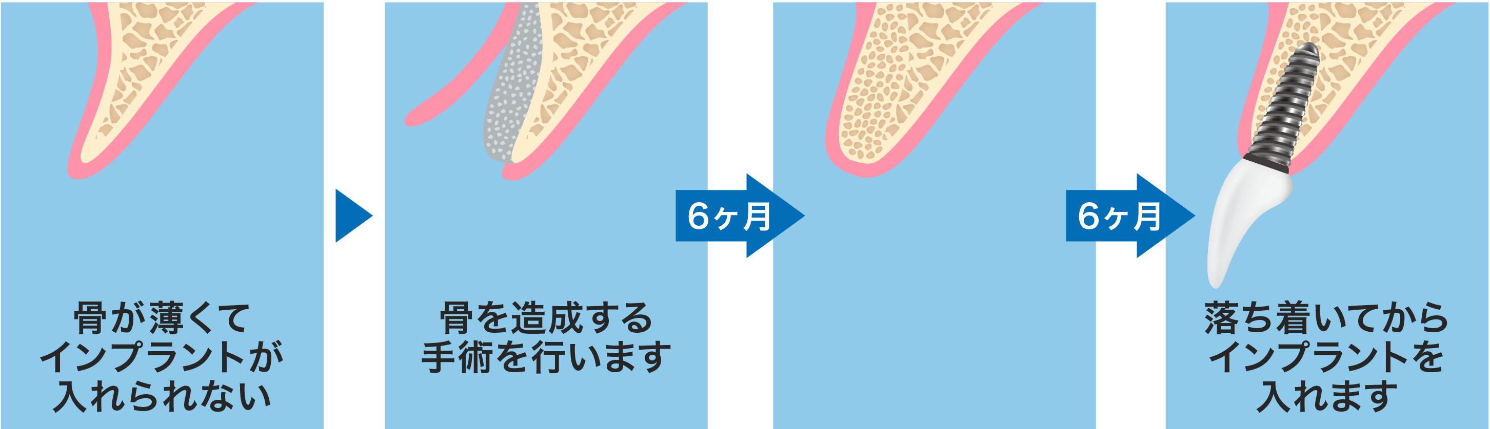 上顎前歯部の場合の流れ