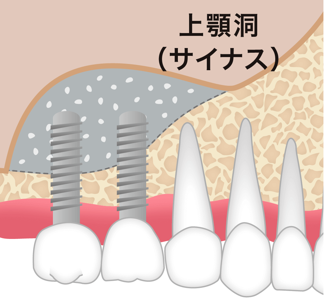 上顎奥歯の場合