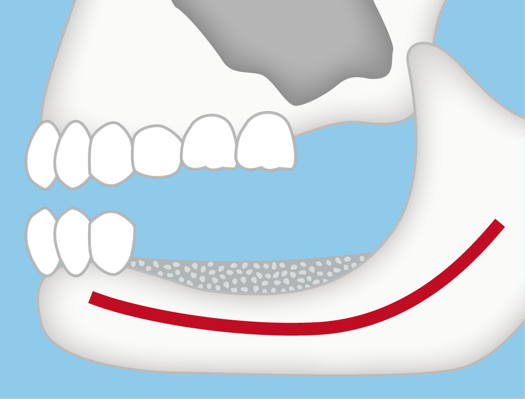 下顎小臼歯から臼歯の場合