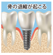 補綴物の精度