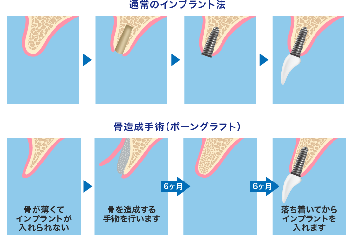 前歯のデメリット