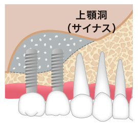 上顎奥歯の場合