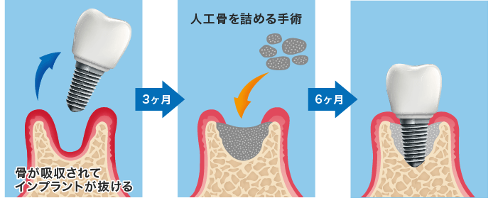 下顎奥歯の場合