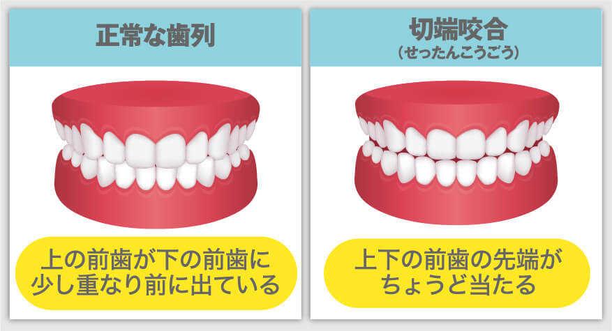 切端咬合の治療法