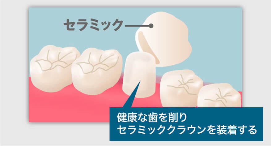 切端咬合の治療法