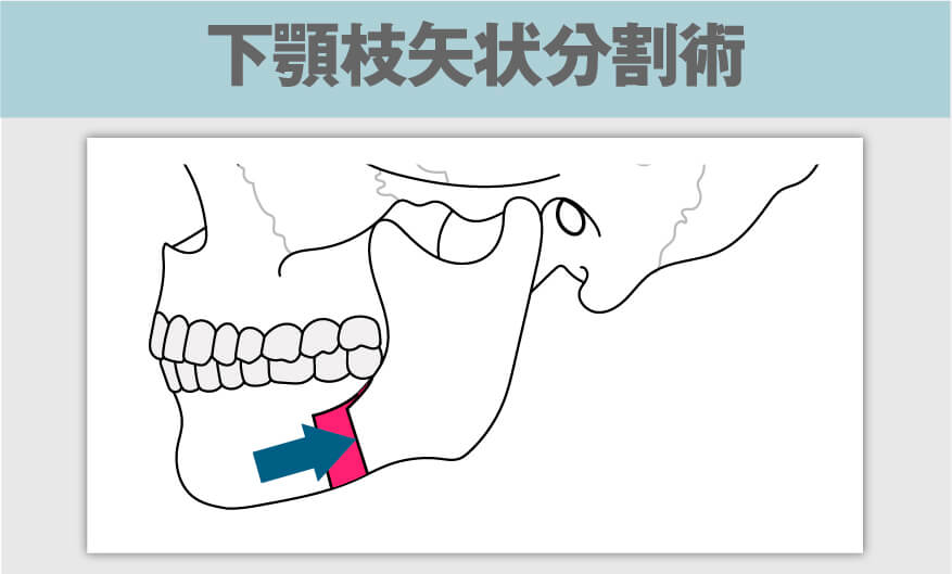 顎矯正手術