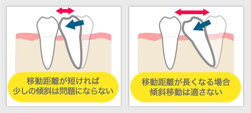 マウスピース矯正