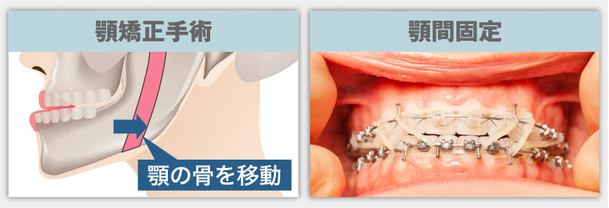 顎矯正手術が必要