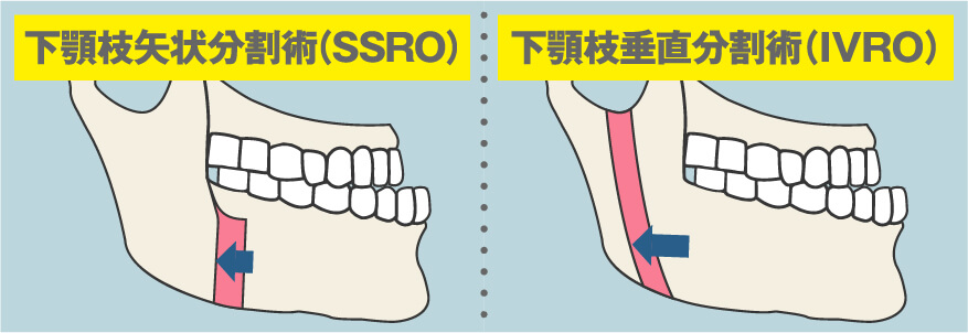 Eラインでの判定方法