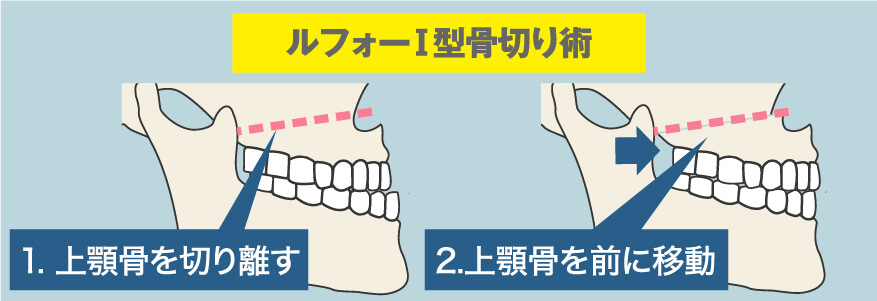 Sラインでの判定方法