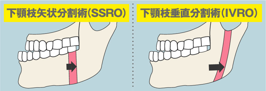 顎矯正手術（骨切り手術）