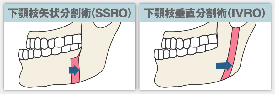 Eラインでの判定方法