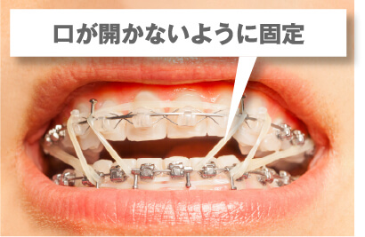 Sラインでの判定方法