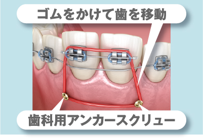 インプラント矯正