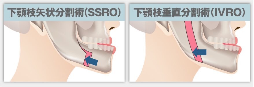 下顎骨骨切り手術