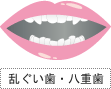 乱ぐい歯・八重歯
