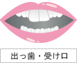 出っ歯・受け口