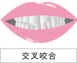 交叉咬合(こうさこうごう)