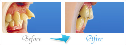 セラミック法での歯列矯正