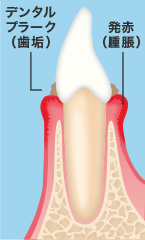 歯肉炎イメージ