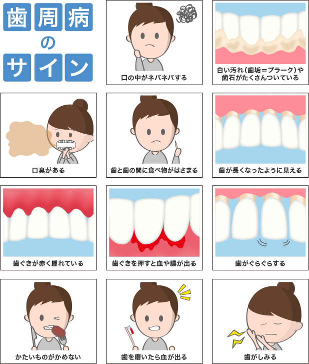 歯周病のサイン 口の中がネバネバする 白い汚れ(歯垢=プラーク)や歯石がたくさんついている 口臭がある 歯と歯の間に食べ物がはさまる 歯が長くなったように見える 歯ぐきが赤く腫れている 歯ぐきを押すと血や膿が出る 歯がぐらぐらする かたいものがかめない 歯を磨いたら血が出る 歯がしみる