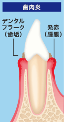 歯肉炎イメージ