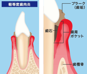 軽等度歯肉炎イメージ