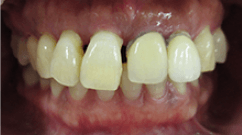 中等度歯周炎の症例写真