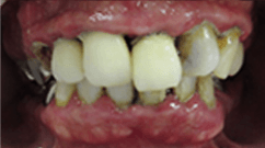 重度歯周炎の症例写真