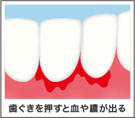 歯ぐきを押すと血や膿が出る