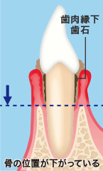 歯周病イメージ
