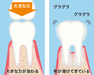 咬合性外傷イメージ