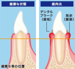 健康な状態 歯肉炎