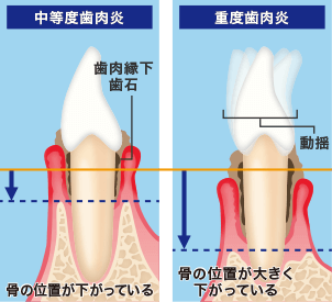 中等度歯肉炎 重度歯肉炎