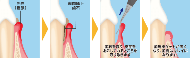 歯周病治療イメージ