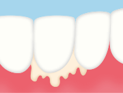 歯周病で歯茎から膿が出る場合