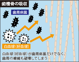 歯槽骨の吸収 白血球（好血球）が歯周病菌だけでなく、歯周の線維も破壊してしまう