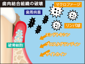 歯肉結合組織の破壊
