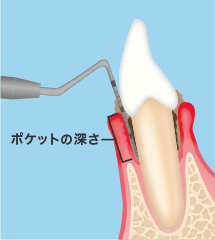 歯周ポケットの深さイメージ