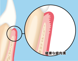 健康な歯肉溝