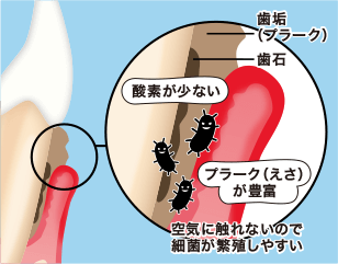 空気に触れないので細菌が繁殖しやすい