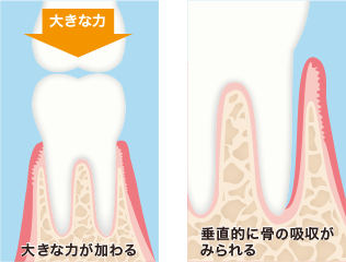 大きな力が加わる 垂直的に骨の吸収がみられる