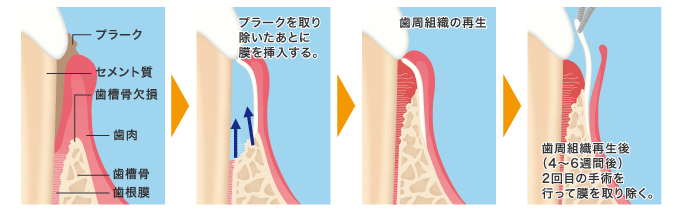 GTR法の図