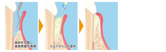 エムドゲイン法の図