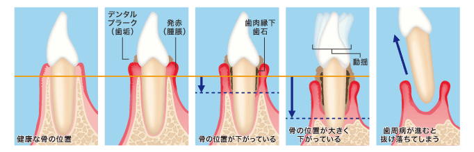 歯槽膿漏