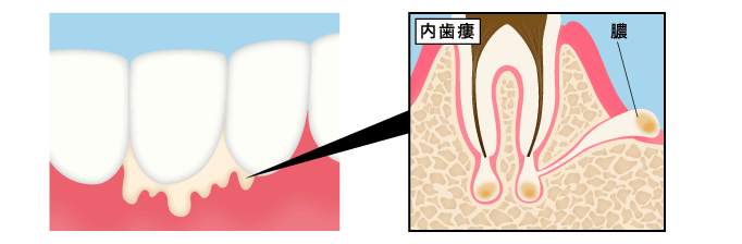 内歯痩