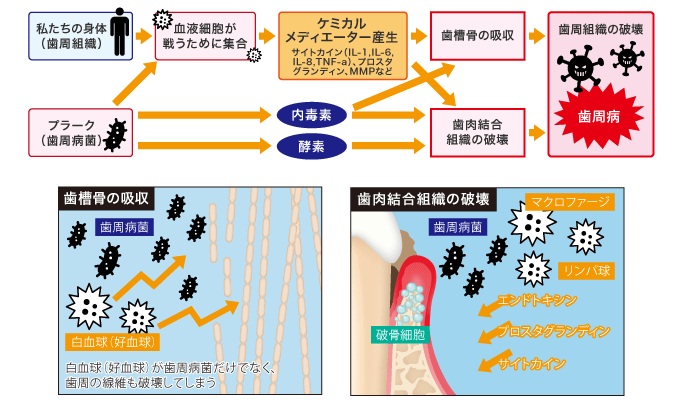 歯肉炎から歯周病への図